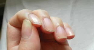 natural-treatements-for-broken-and-exfoliated-nails-without-effort-and-money-f
